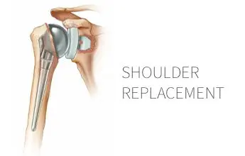 Shoulder Replacement Surgery – FAQ with Dr. Timothy Pater