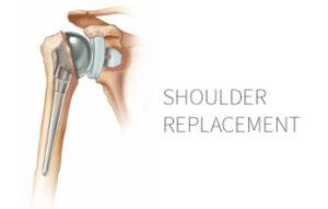 Shoulder Replacement Surgery –  FAQ with Dr. Timothy Pater
